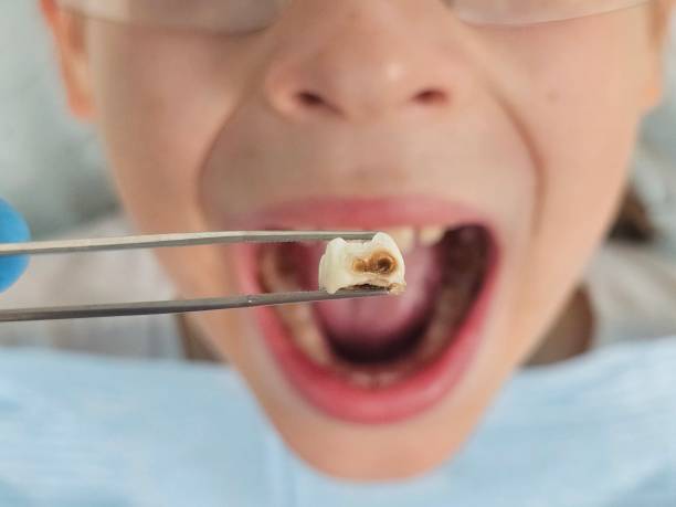 Best Pediatric Emergency Dentist in Burley, WA