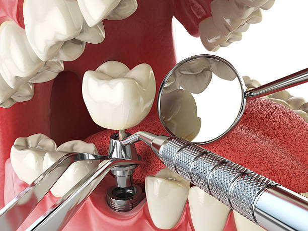 Best Emergency Dental Services for Seniors in Burley, WA